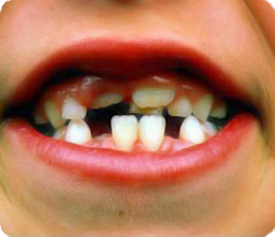 молочные зубы